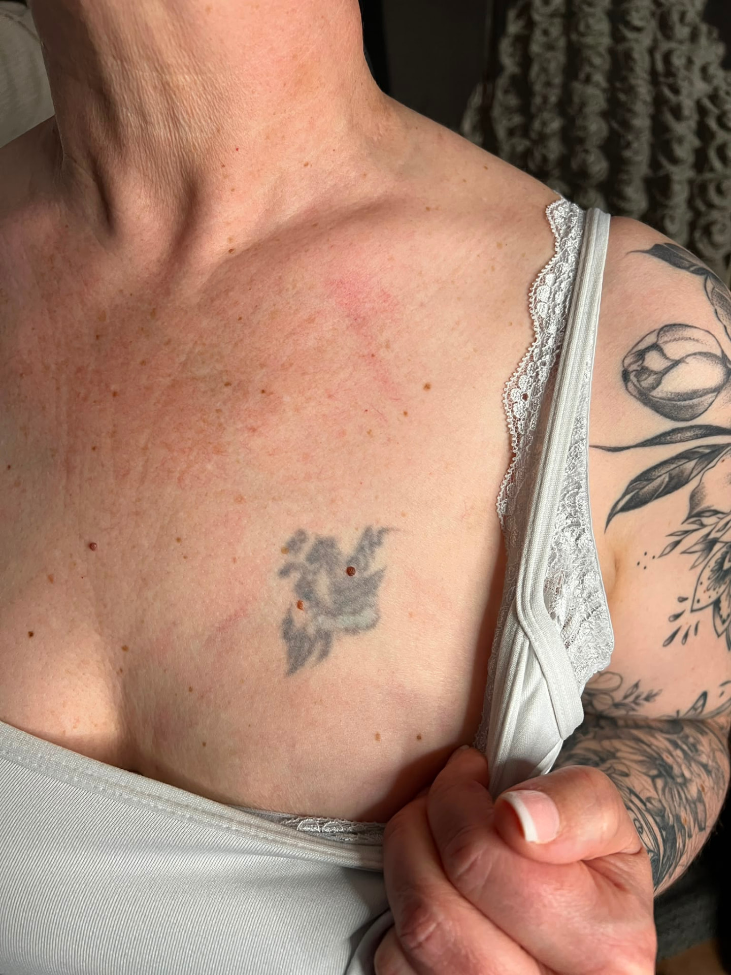 Cover-up · Brust – vorher