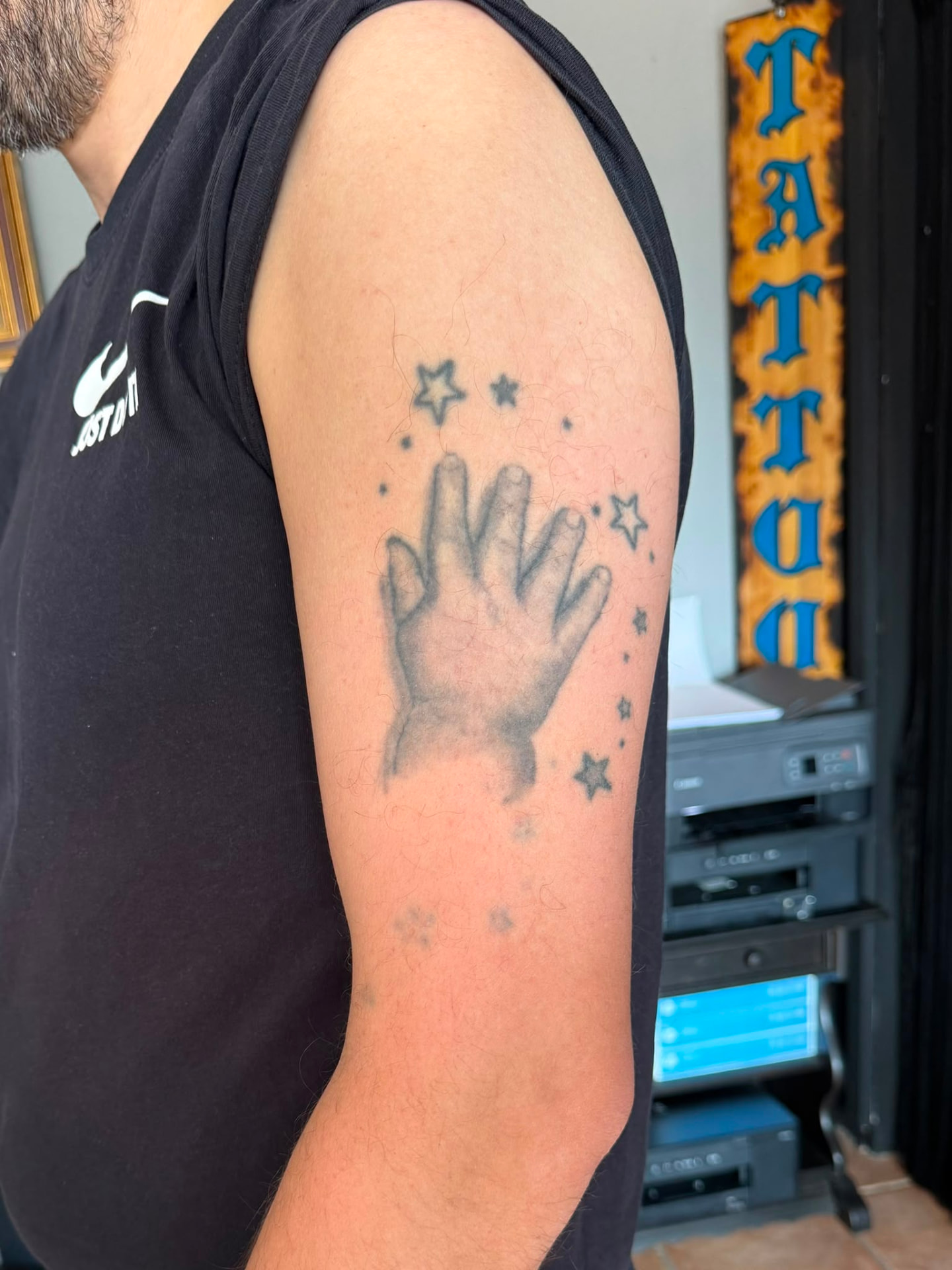 Cover-up · Oberarm – vorher