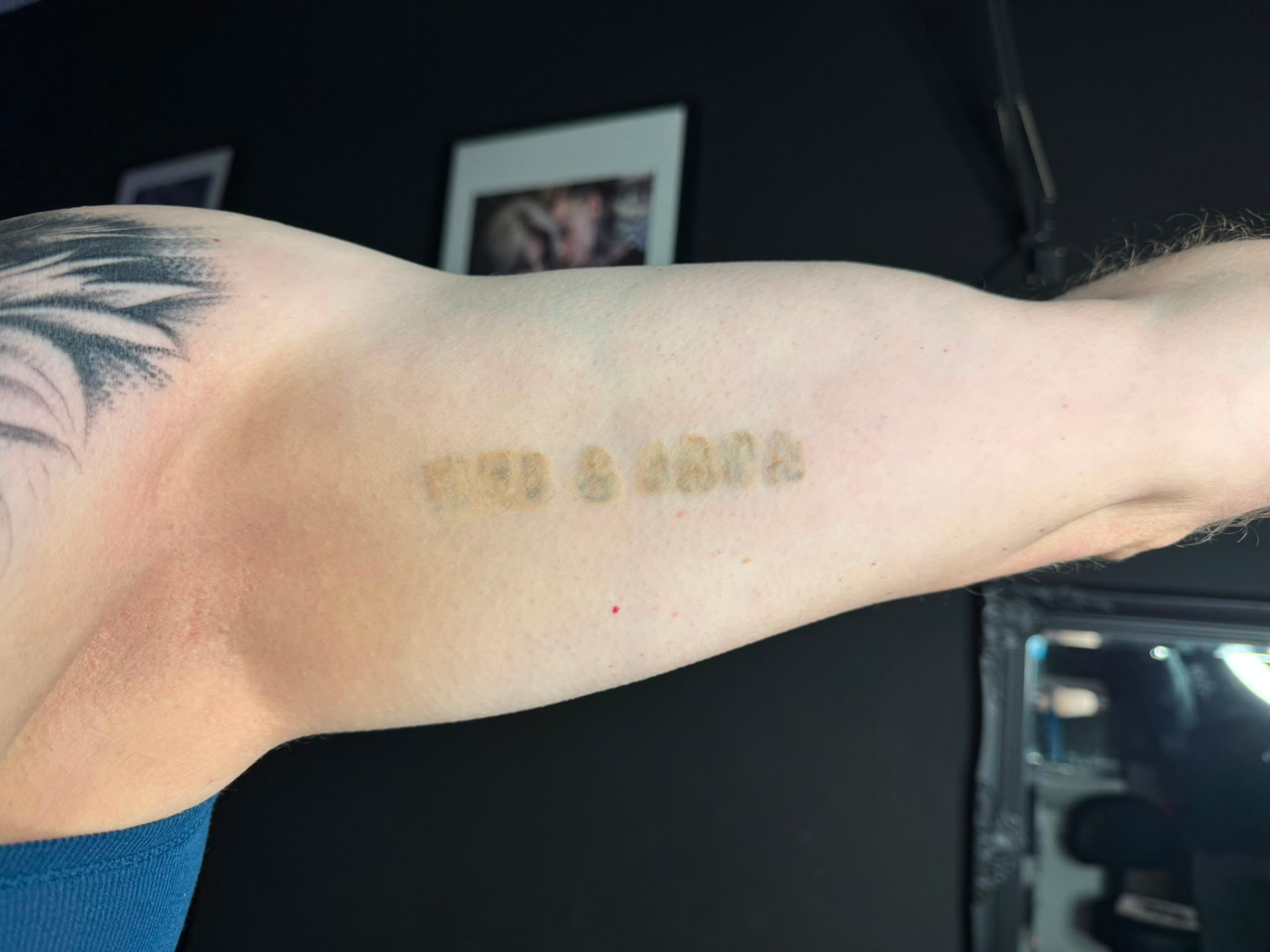 Cover-up · Oberarm – vorher
