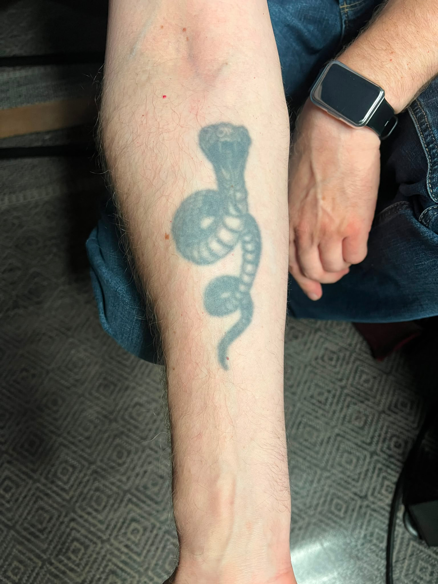 Cover-up · Bein – vorher