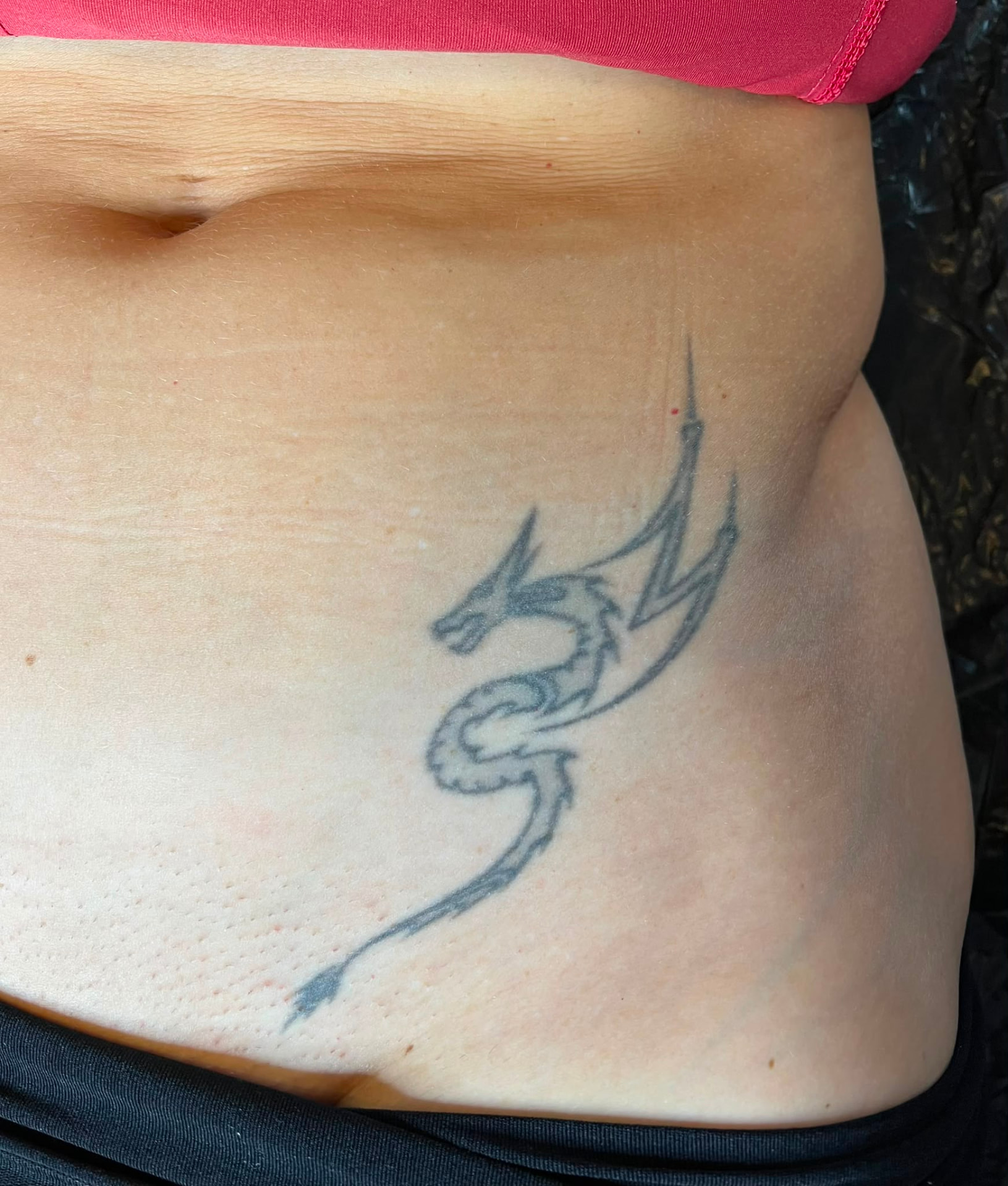 Cover-up · Bauch – vorher